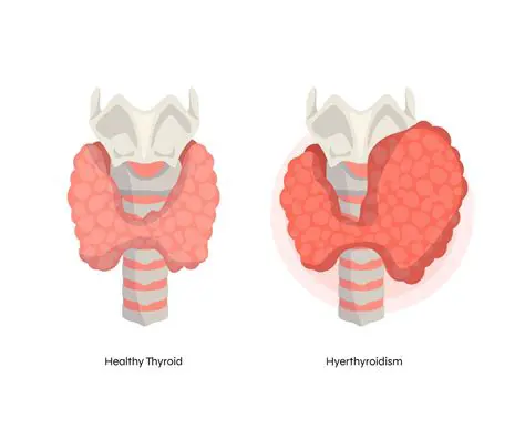 Background of Hyperthyroidism