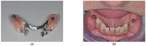bilateral free end lower jaw