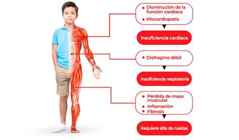 Causas da Distrofia Muscular Progressiva