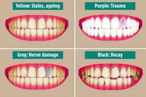 Changes in the texture or color of the teeth