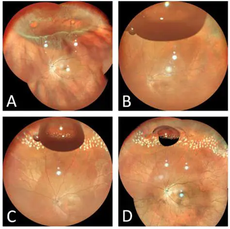 Client Statements and Retinal Detachment