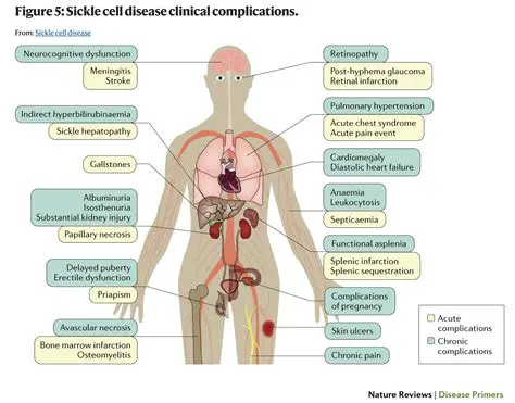 Complications of Sickle Cell Anemia