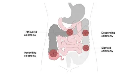 Consider the Function of Stoma