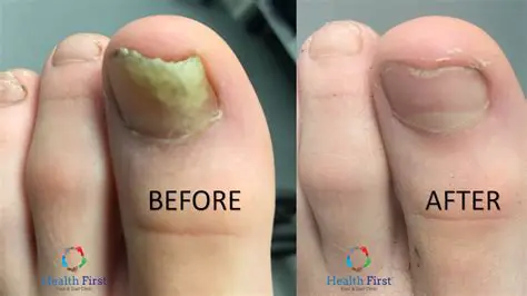 CPT Codes for Fungal Nail Culture
