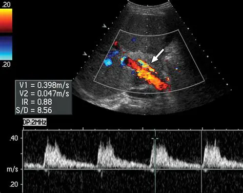Doppler Ultrasound in Liver Disease