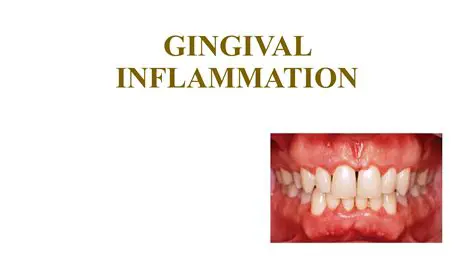 Factors That Can Aggravate Gingival Inflammation