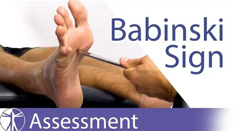 Frequently Asked Questions about the Babinski Sign