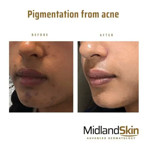 Hyperpigmentation reduction