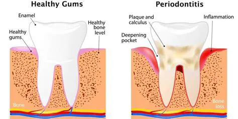 Identifying Irreversible Periodontal Symptoms