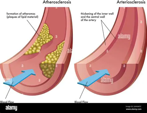 Key Differences Between Atherosclerosis and Arteriosclerosis