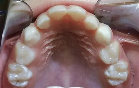 O Uso Prolongado da Chupeta