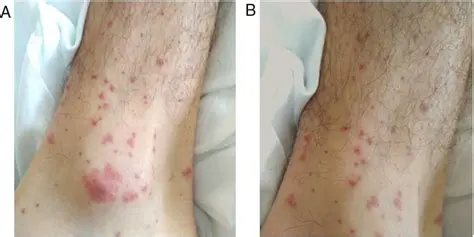 Palpable Purpura and Folliculitis