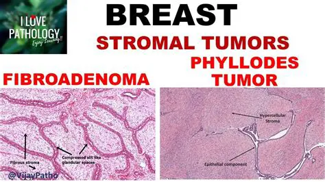 Phyllodes tumors are not derived from existing fibroadenomas