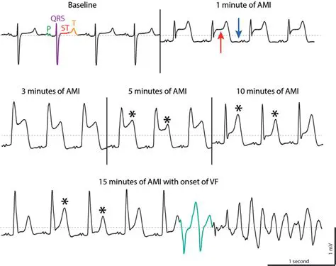Rhythms Associated with Acute Myocardial Infarction
