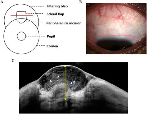 Routine monitoring of IOP and Bleb morphology