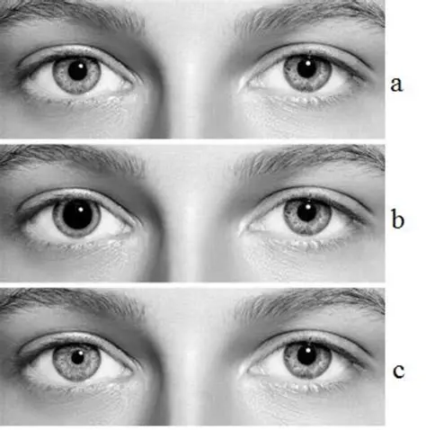 Significant difference in pupil diameter before and after giving intravenous ketorolat
