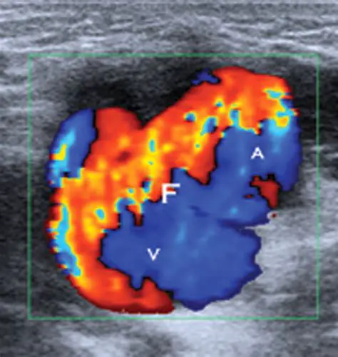 Spectral Doppler Waveform in Arteriovenous Fistulas