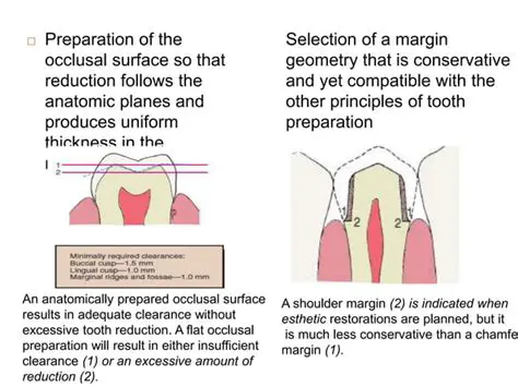 Structure of the tooth preparation overlying the pulp