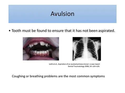 Symptoms of Tooth Avulsion