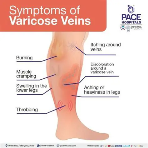 Symptoms of Varicose Veins