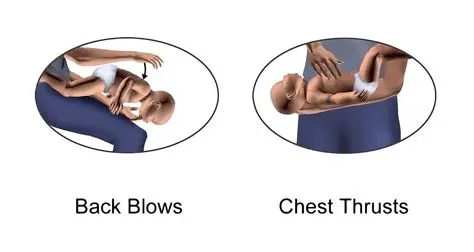 The Correct Direction for Abdominal Thrusts
