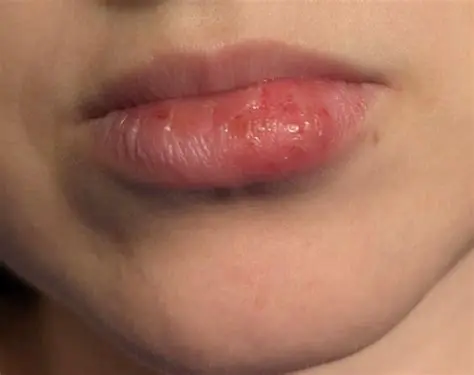 The Effect of Listering Age