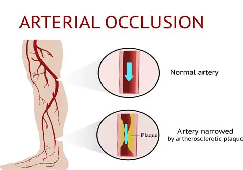 The Effects of Arterial Occlusion on Blood Flow