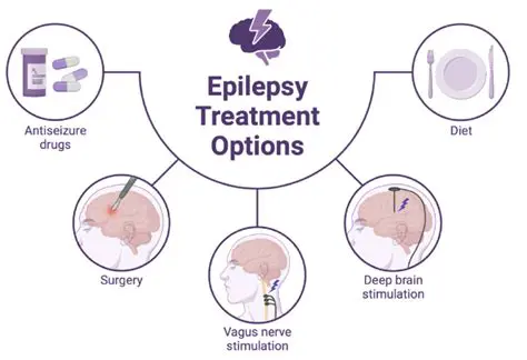 Treatment Options for Epilepsy