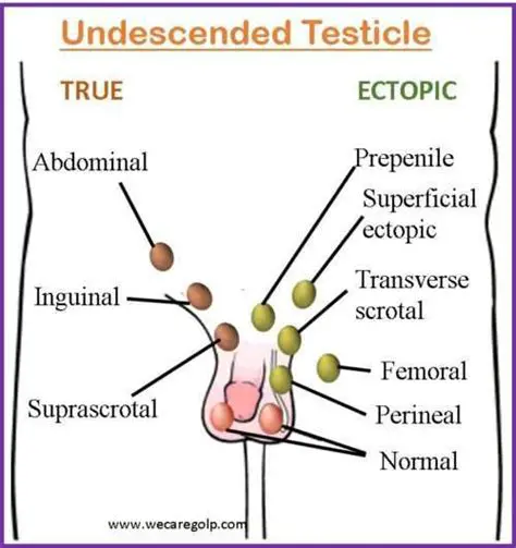 Types of Undescended Testicles
