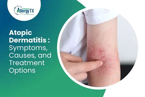 Understanding Atopic Dermatitis