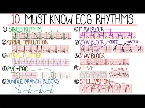 Understanding ECG Patterns