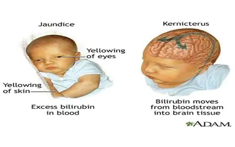 Understanding Jaundice Neonatorum